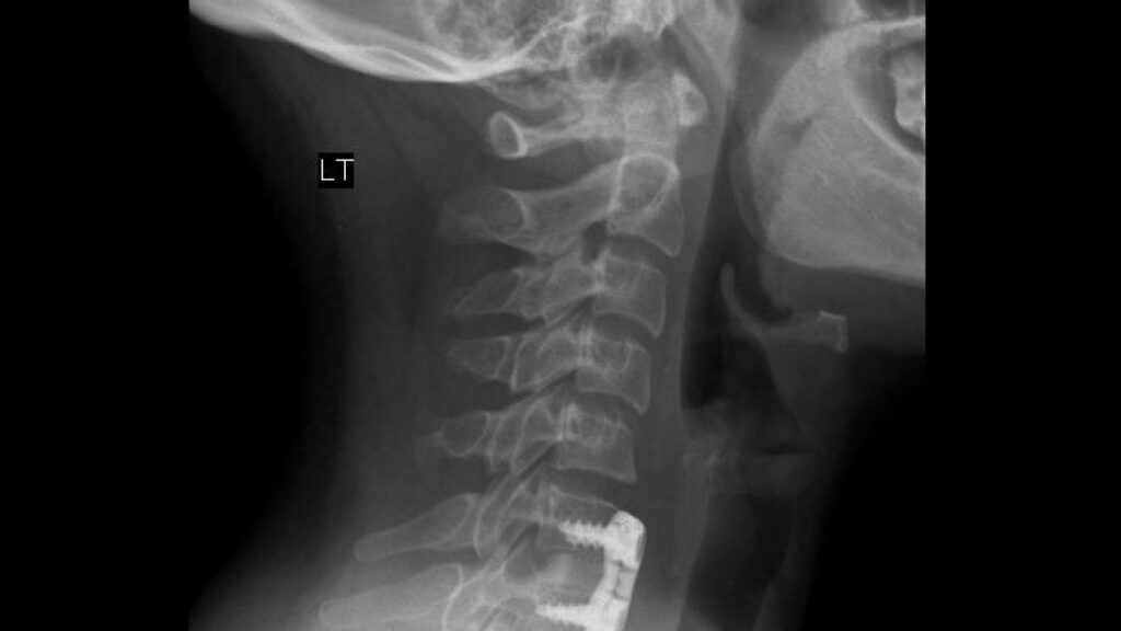 X-ray image showing cervical spine injury after a car accident in Tulsa, Oklahoma.